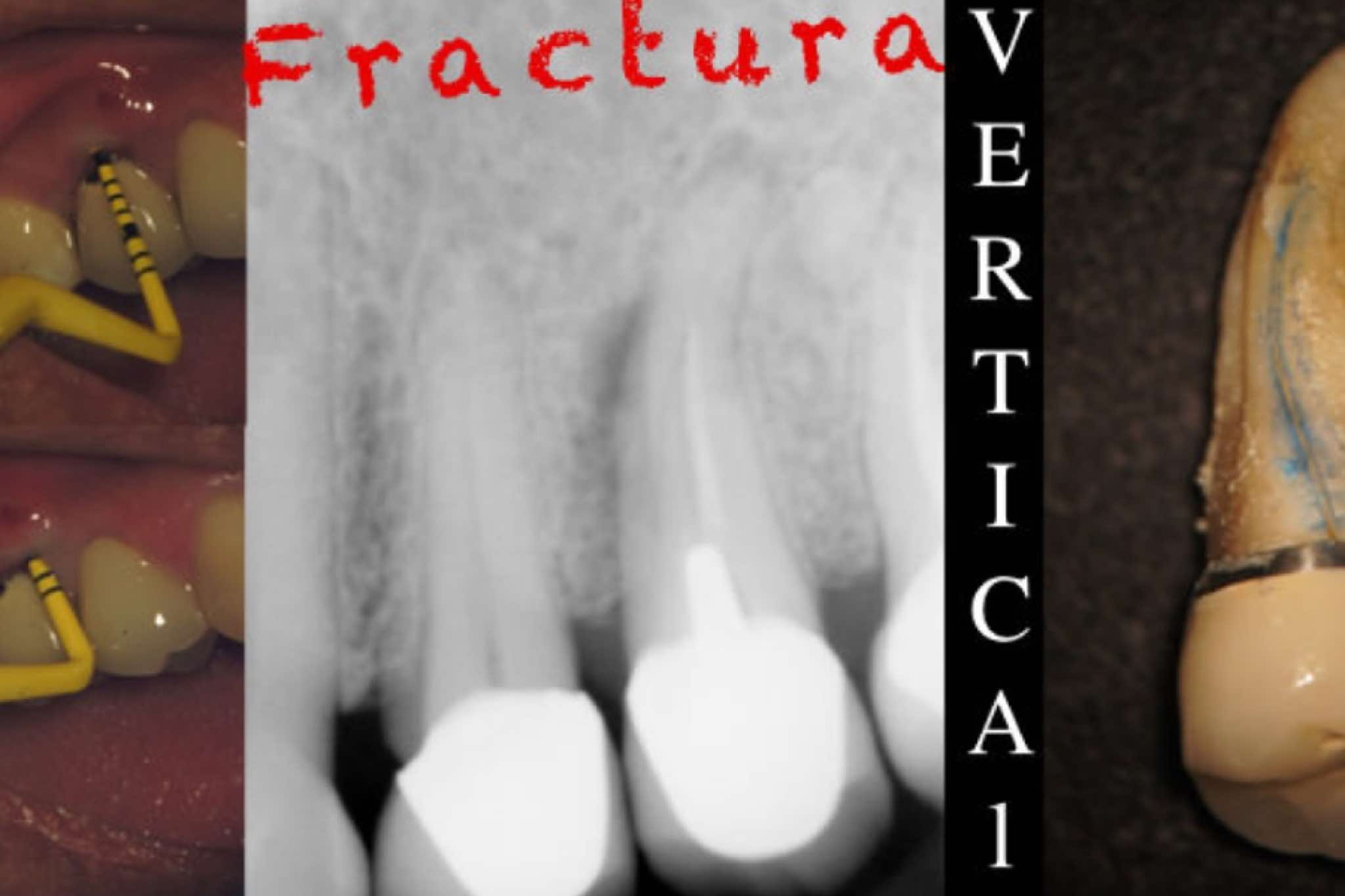 exibid_fracturavertical2